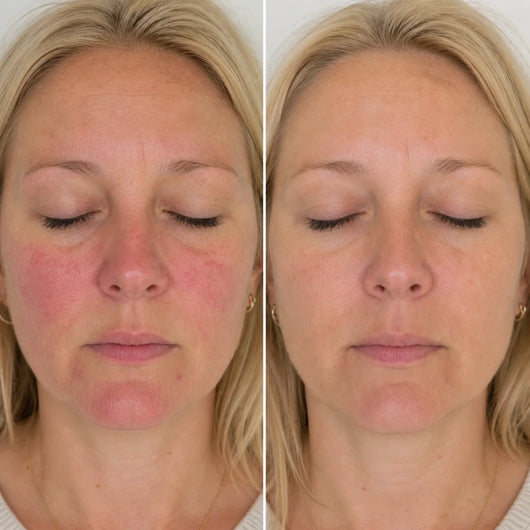 Rosayra Anti-Rötungen Serum