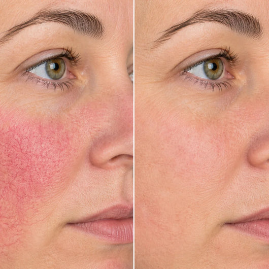 Rosayra Anti-Rötungen Serum
