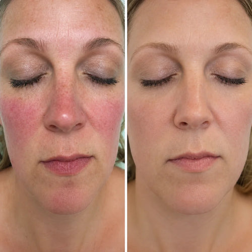 Rosayra Anti-Rötungen Serum