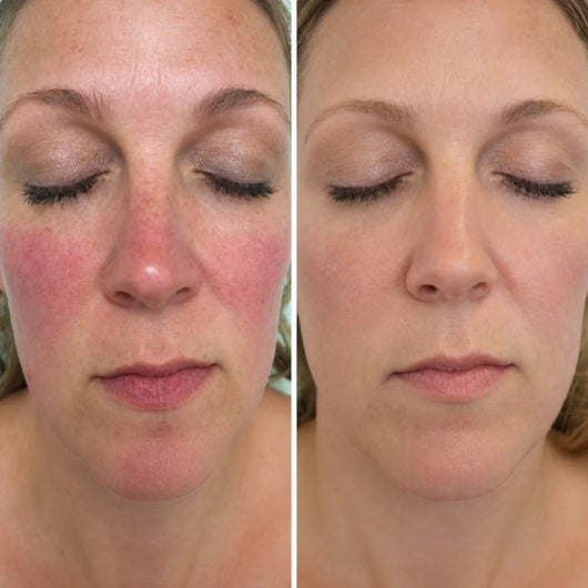 Rosayra Anti-Rötungen Serum